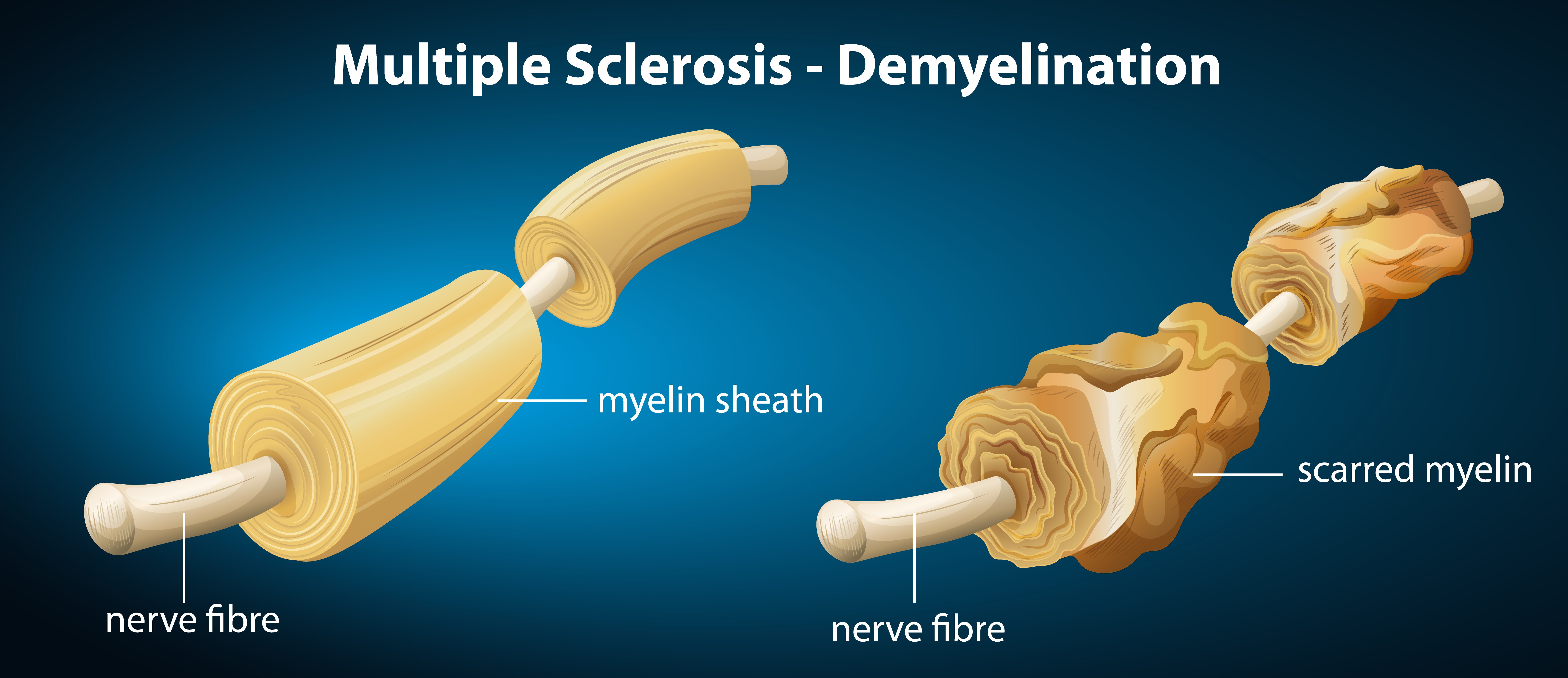 The destruction of the myelin sheath on the axon. Damaged myelin. Neuron affected by multiple sclerosis. 