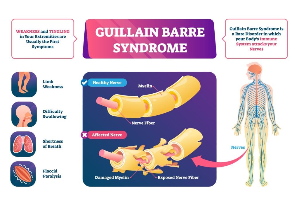 Guillain Barre syndrome vector illustration. Labeled muscle disease scheme.