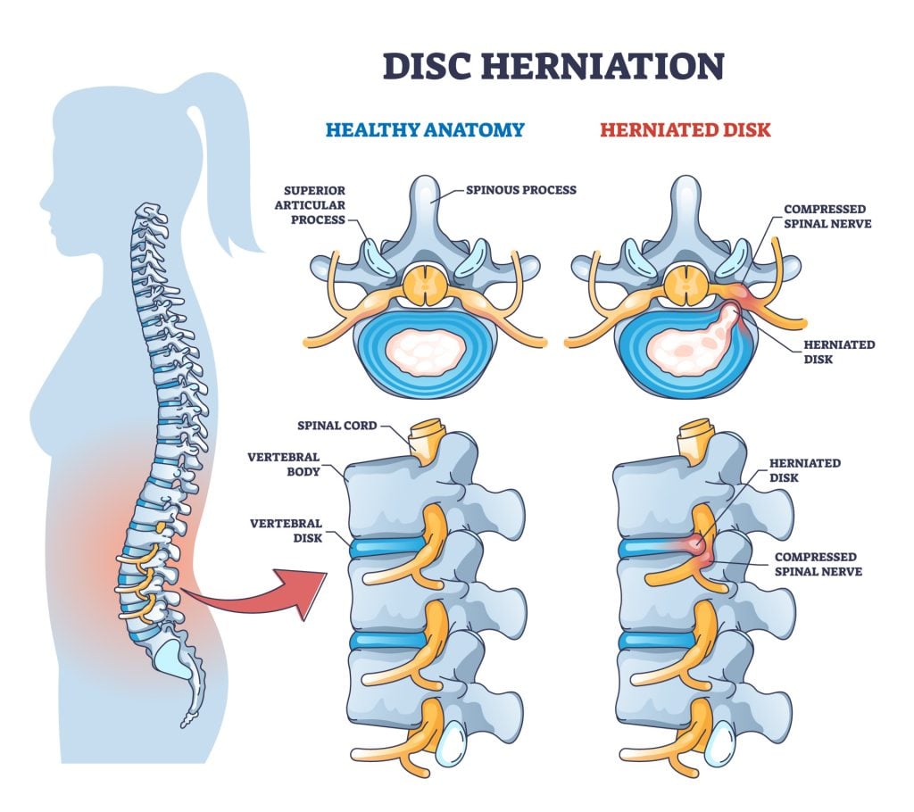 Disc herniation or spine nerve compression vs healthy anatomy outline diagram. Labeled educational scheme with superior articular process and herniated disk vector illustration. Vertebral body trauma.