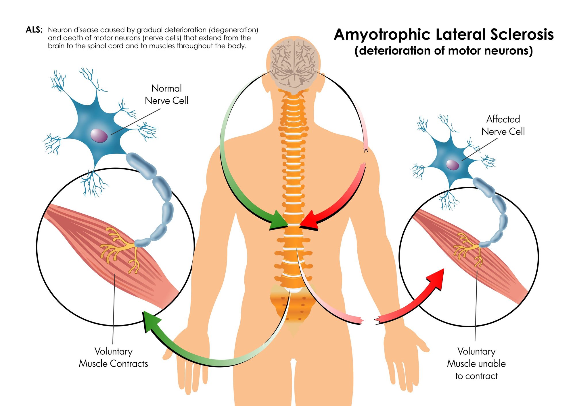 There are many forms of motor neuron disease, a common one being amyotrophic lateral sclerosis (ALS)