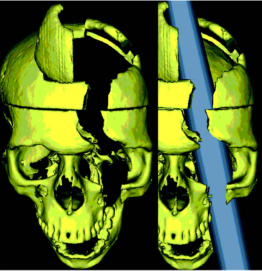 Phineas Gage brain image from Ratiu et al., (2004) 